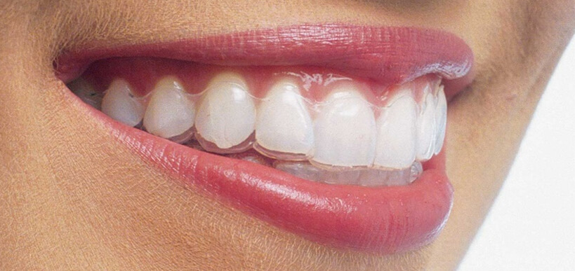 Invisalign First – Smileworks Dental Services